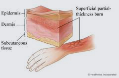 thickness burn vs 4th degree burn